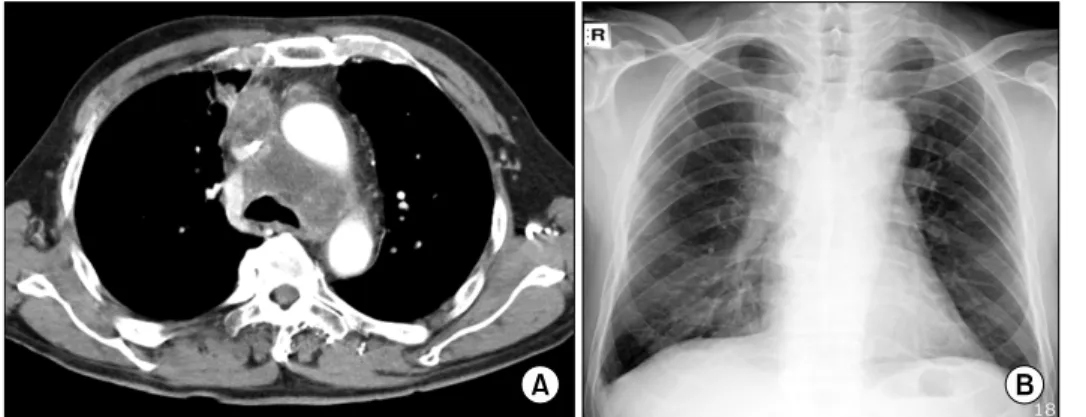 Fig. 3.  (A)  Chest  computed  tomo- tomo-graphy  shows  mediastinal  lymph  node  enlargement  after  the  third  cycle  of  docetaxel