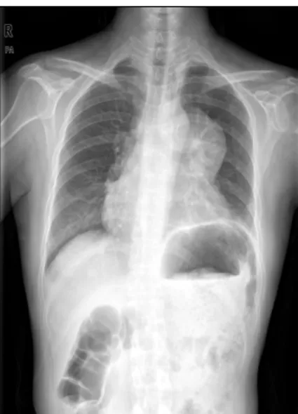 Fig. 1.  Chest  X-ray  showing  the  superior  mediastinal  mass.