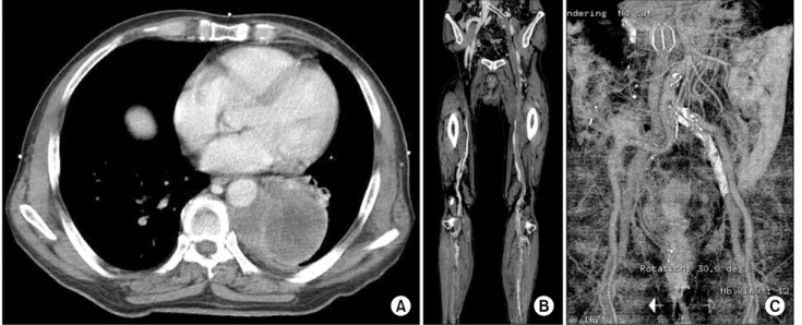 Fig. 1.  Chest  CT  shows  a  7.8  cm  heterogeneously-enhancing  mass  in  the  medial  aspect  of  the  left  lower  lobe  (A)