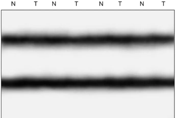 Fig. 1.  Representative  SSCP  of  the  JAK1  gene  in  the  non-small  cell  lung  cancers