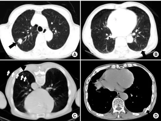 Fig. 1.  The  initial  chest  CT  scan  showed  (A)  about  a  1.7x1.5  cm  sized  well-defined  nodule  with  a  lobulated  shape  in  the  right  upper  lung  (solid  arrow)  and  (B)  a  well-defined  small  nodule  in  the  left  lower  lung  just  ben