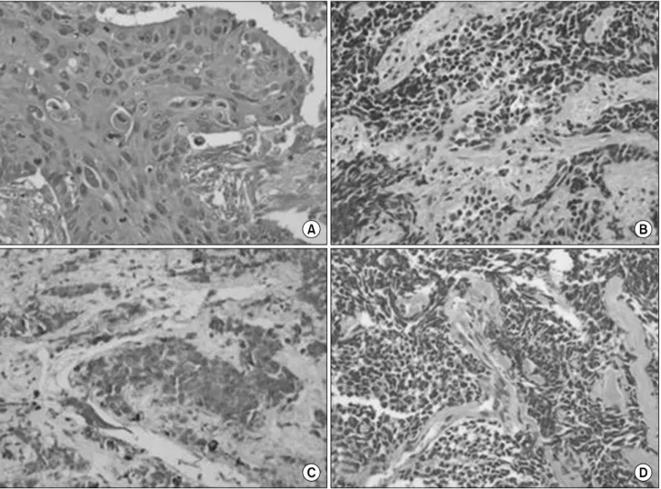 Fig. 3.  The  report  from  the  pathologist  revealed  (A)  squamous  cell  carcinoma  for  the  nodule  of  the  right  upper  lobe  (H&amp;E  stain, 