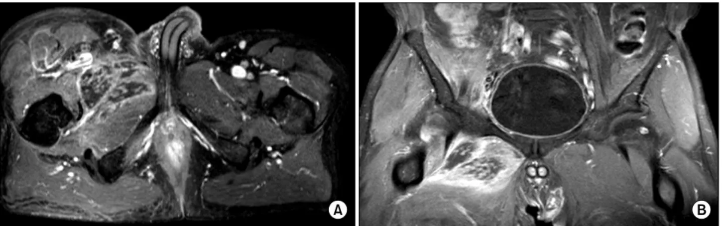 Fig. 1.  Osteolytic  bone  metastasis  in  the  right  acetabulum  on  the  CT  scan. 절 통증으로 인하여 활동이 불편하여 ECOG  2로 관찰이 되 었으며,  마약성  진통제를  복용하면서도  지속적인  통증을 호소하였다