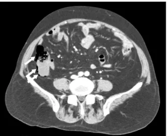 Fig. 1.  Abdominal  CT  shows  air  in  the  wall  of  the  ascending  colon  (arrows).
