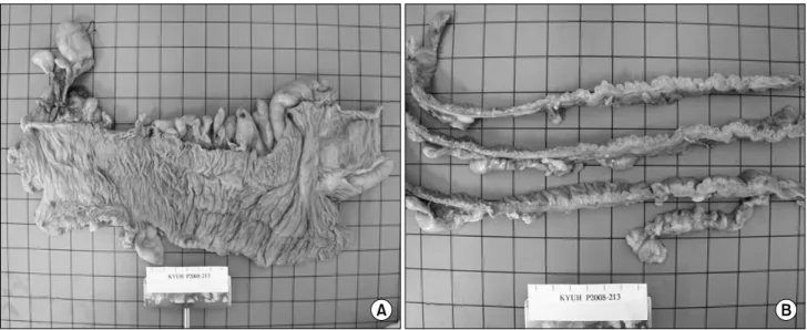 Fig. 2.  (A)  Gross  appearance  of  the  right  hemicolectomy  specimen.  (B)  The  section  shows  numerous  air-containing  cysts.