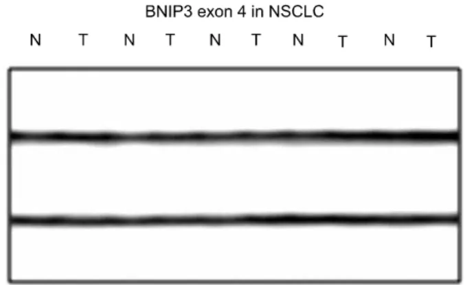 Fig. 1. Representative  SSCP  of  BNIP3  gene  in  the  non-small  cell  lung  cancers