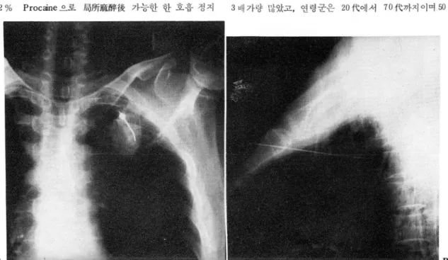 Fig.  l.  A.B .  Fine needle is  introduced to the mass at left upper lobe through anterior chest wall
