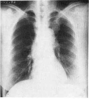 Fig.  7.  Numerous  hyphae  with  branching  pattern was  aspirated  from  left upper lobe mass and diagno