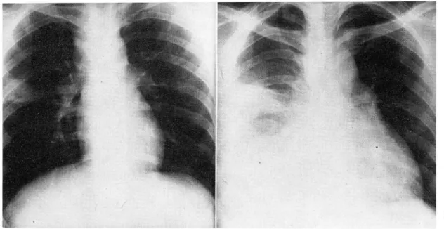 Fig.  11.  A.  Superior  mediastinum  is  widened  and  triangular  shaped  pneumonic  infiltration  is  noted  at  right  mid.lung  field