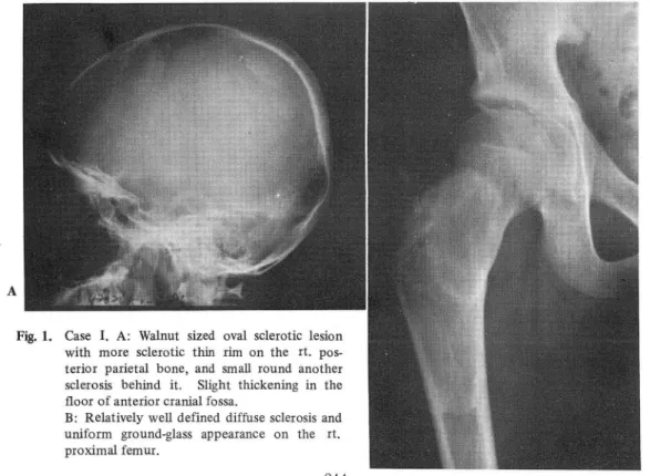 Fig.  1.  Case  I.  A:  Walnut  sized  oval  sclerotic  lesion  with  more  sclerotic  thin  rim  on  the  r t