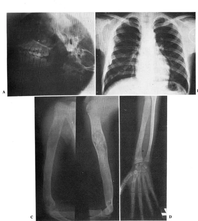 Fig.  3.  Case III. A:  Diffuse sclerosis on skull base and somewhat haziness in maxillary sinus