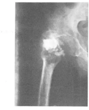 Fig.  2.  Osteosarcoma  o f  osteoblastic  type  in  distal  femur with soft tissue ext ension 