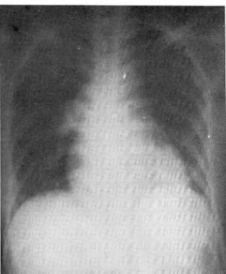 Fig.  1.  A  large  round  defined  soft  tissue  mass  density  on  RT.  lower  lobe  of superior  segment  area