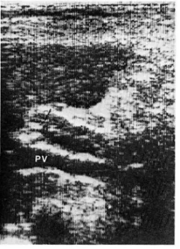 Table 11.  Ul trasonographic Findings of Biliary  Ascaris Worm 