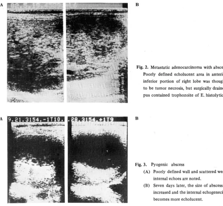 Fig.  3.  Pyogenic  abscess 