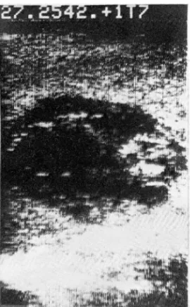 Fig. 4.  Pyogenic abscess 
