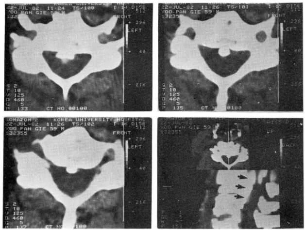 Fig. 5.  Posterior longitudinal 1i gament ossification at cervical spine. 