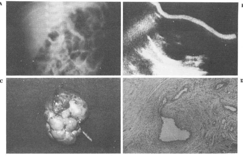 Fig.  1.  A.IVP  : Non visualization  of the left kidney . 