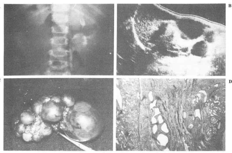 Fig. lI.  A. IVP : Non visualisation of the right kidney with faint  rim  sign  at lower margin  (arrows)