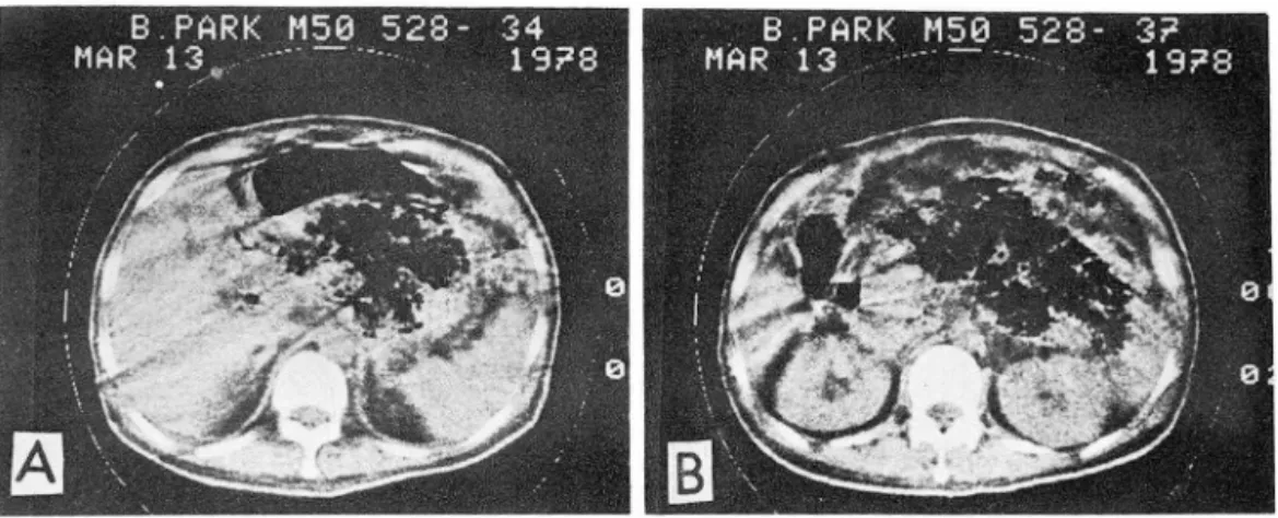 Fig. 4.  Necrotic - hemorrhagic  pan다eatitis. 