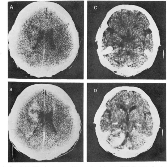 Fig.  1.  Cases  1 : Pre-(A)  and  post-contrast  (B)  scans  taken  in January ,  1980