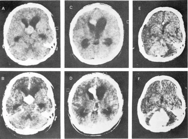 Fig. 2.  Case  II  ; Pr e- (A ,  C)  and  post-contra앙  (B ,  D)  scans  in April ,  1970  Lateral ventri c1 es  are  dilated ,  and  hi방1  den성ty  mass  with  homogeneous  contrast  enhancement  is  at  the  floor  of  the  third  ventri c1 e ,  septum  p