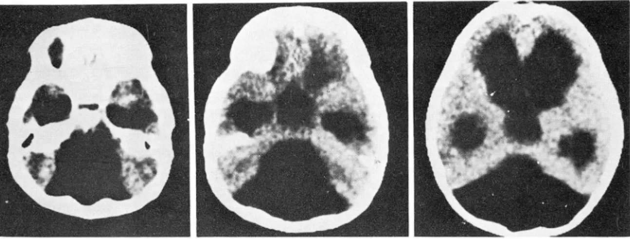 Fig.  1.  (Case  1)  CT  scan  shows  huge  triangular-shaped  cystic mass occupying almost  the entire  posterior  cranial  fossa  with  small  compressed  cerebellar  hemisphere  in  the  lateral  portion ,  indicating huge  cystic  dilatation  of  the  