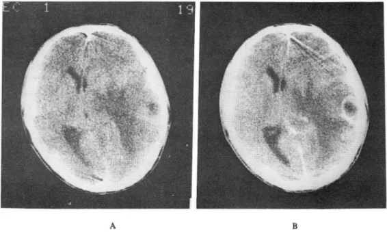 Fig. 2.  A.  Before  contrast  enhancement ,  there is a  purely  low  density  in  the right temporallobe with  severe surrounding edema