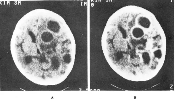 Fig .4.  A.  Before  contrast  enhancement ,  there  are  multiple  low  density  with  faint  dense  or  dense  ring  surrounded  by  mild  or  moderate  edema  and a  isodense nodule in the right hemisphere