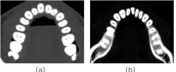 Fig. 13. A CT slice with the closest distance to the  crown stop curve. (a) CT Slice which matched closely 