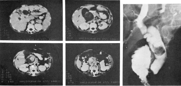 Fig.  1.  CBD  stone at pancreatic level: 