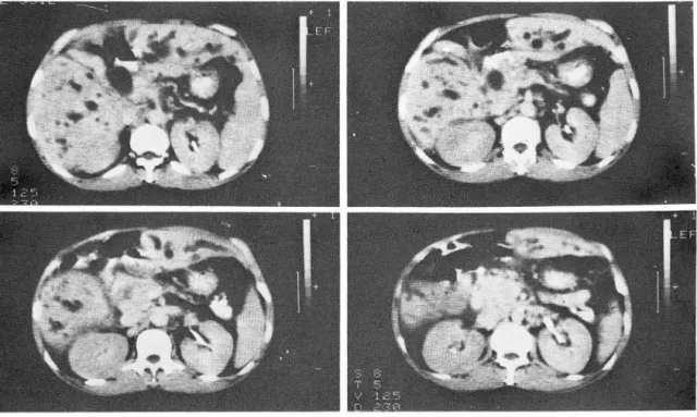 Fig. 3.  Pancreas head cancer : 