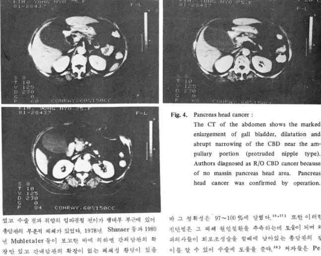 Fig. 4.  Pancreas head cancer  : 