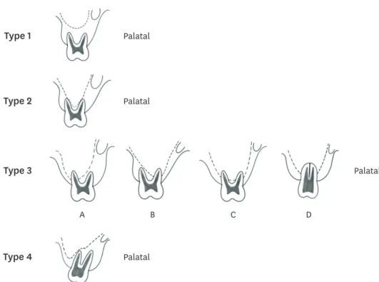 Figure 2. Illustrations of the classification of the relationship between the maxillary molars and the sinus floor.