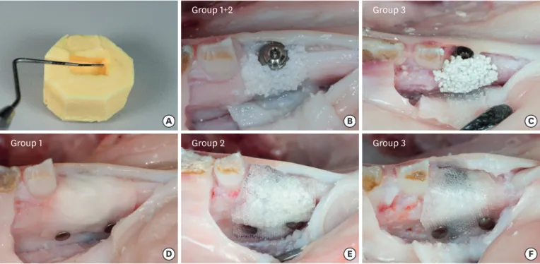 Figure 2. Silicone mould and application of material for guided bone regeneration. (A) The silicon mould used to standardize the amount of bone substitute  material