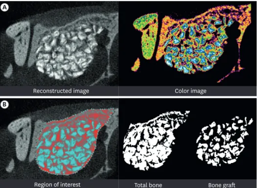 Figure 2. Radiographic analysis: micro-CT. (A) Reconstructed image of micro-CT. (B) Region of interest: new bone  volume was calculated as the remaining graft volume subtracted from the total augmented volume