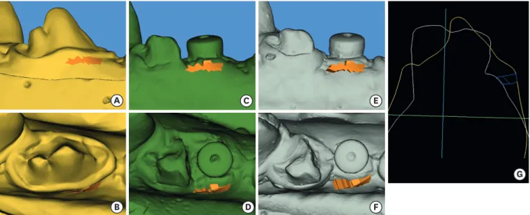 Figure 3. Digital analysis of surface scans at (A, B) baseline, (C, D) post-implant placement, and (E, F) sacrifice at an implant site from the control group