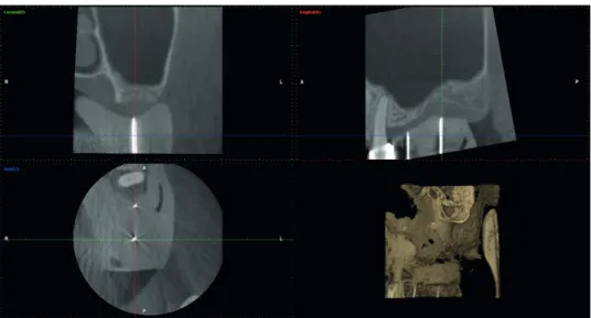 Figure 1. Images were studied in different views. Slices were first oriented at the midcrest of the edentulous area.