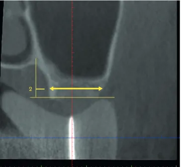 Figure 3. A horizontal line was drawn at the reference point, which was 2-mm coronal to the edentulous crest  and was used to measure ridge width.