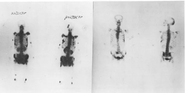 Fig.  1.  48  year  old  woman  with  breast  cancer  Initial  mutiple  bony  metastatic  lesions  disap- disap-peared  after  hormonal  therapy 