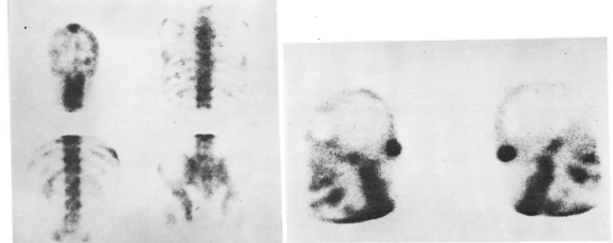 Fig.  3.  2  cases  of  prostatic  cancer  with  multiple  and  singlemetastases 