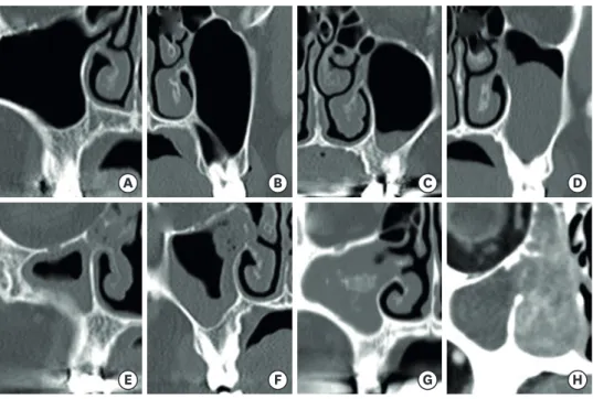 Figure 1. Common maxillary sinus pathologies as shown on coronal computed tomography images of the  paranasal sinus