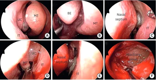 Figure 2. A case of functional endoscopic sinus surgery in a patient with left maxillary sinusitis