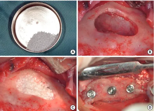 Figure 3. EBH at the implant placement site. Statistically significant differences were observed in comparison to  the EBH measured immediately after the augmentation
