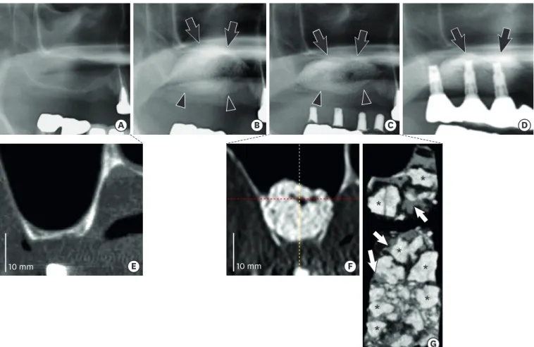 Figure 5G shows a micro-CT image of a bone biopsy specimen at 7 months after augmentation