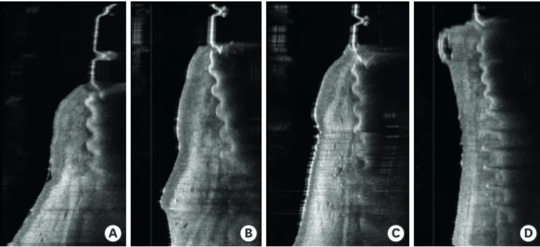 Figure 3. OCT image acquisition in the porcine samples. The mean values of the defect depth measured by OCT  were 3.53 mm (A), 4.17 mm (B), 4.73 mm (C), and 7.17 mm (D), respectively