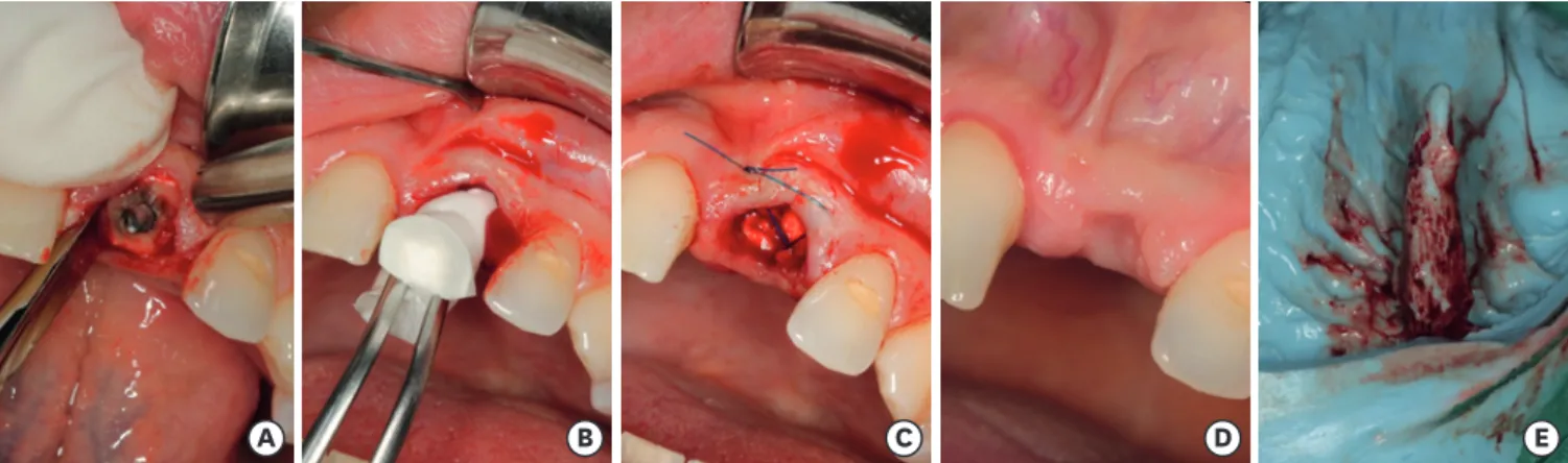 Figure 1. (A) Atraumatic tooth extraction with periotomes and forceps. (B) Introduction of the collagen cone with the membrane