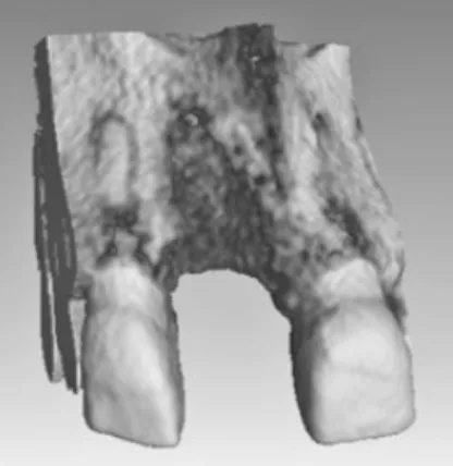 Figure 2. Cone-beam computed tomography image of the alveolus at 8 (±1) weeks after extraction.