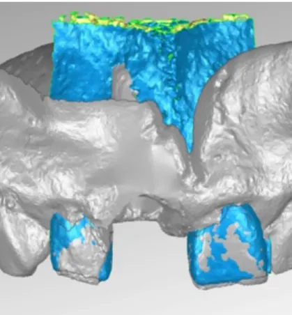 Figure 3. Matching of the models at time T 0  and T 1  via the hard tooth tissues.
