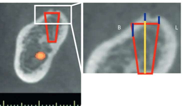 Figure 1. Thickness of the cortical bone at the site of implant placement (red line) on each cross-sectional  computed tomography image